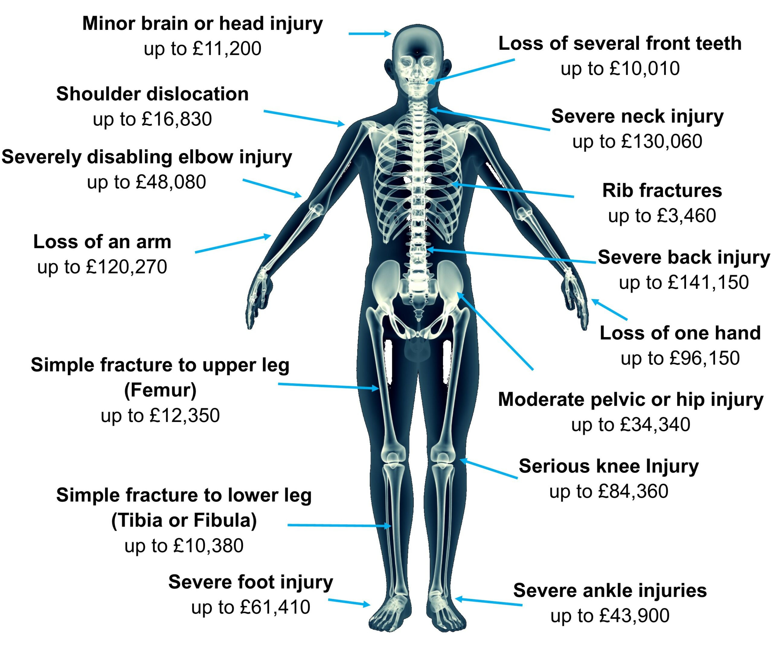 Skeleton Image for Personal Injury Article Relief from holiday Hell