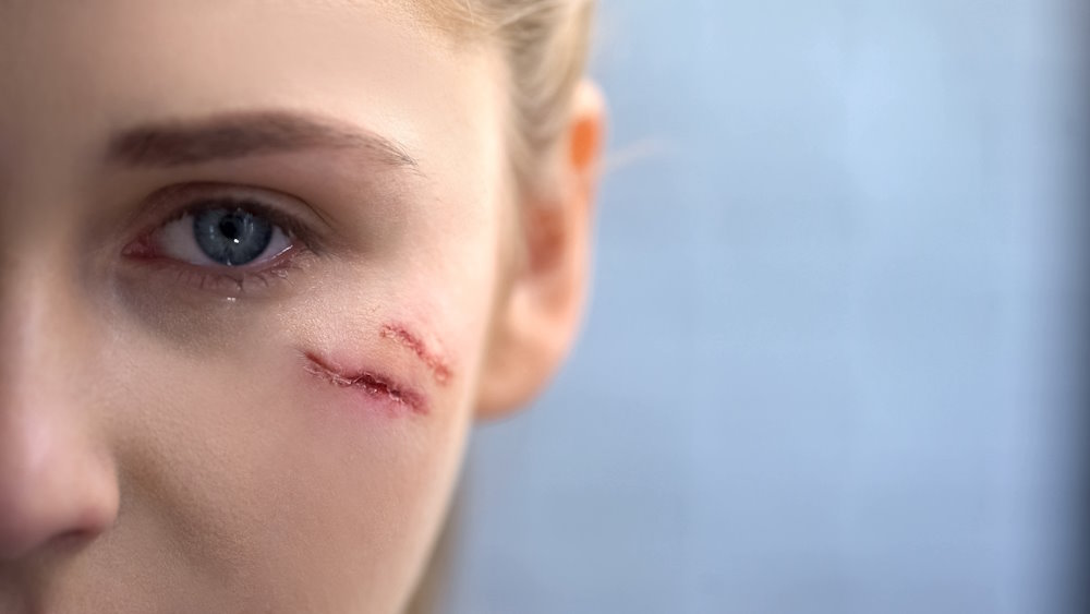 A young woman with a scarred face for Personal Injury Solicitor in Plymouth